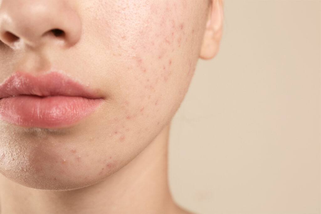 Top 7 Essential Acne-Fighting Ingredients | Botanical Science